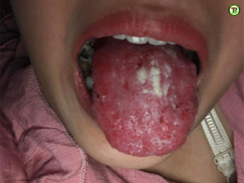 Nấm lưỡi ở người lớn có thể gây chảy máu lưỡi